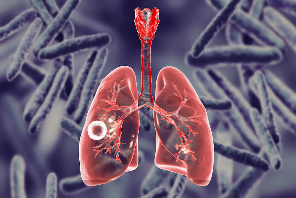 Diagnostico Tuberculose